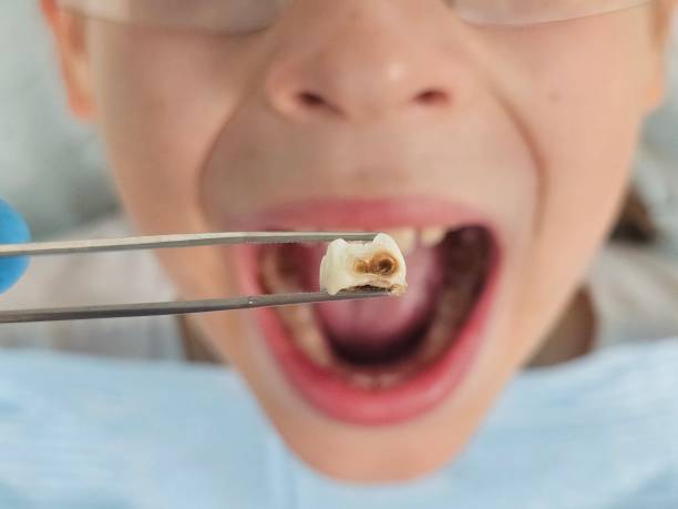 Best Emergency Treatment for Dental Infections or Abscesses in Chester, PA