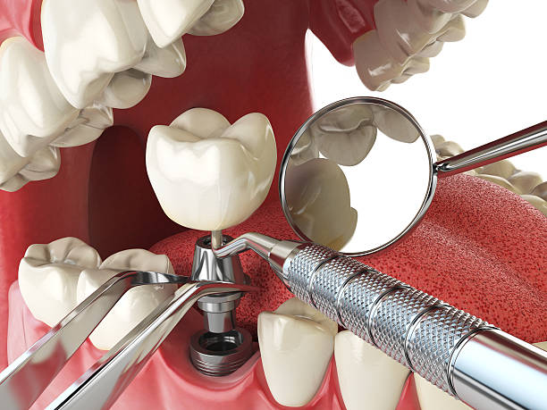 Best Emergency Dental Care for Broken or Chipped Teeth in Chester, PA
